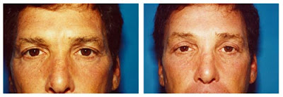 Brow Lift Before And After