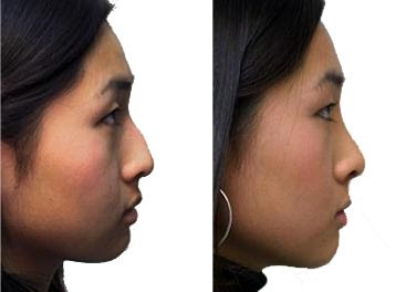 Nose Job Before And After