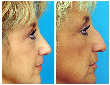 [NoseJob+Before+AndAfter.jpg]