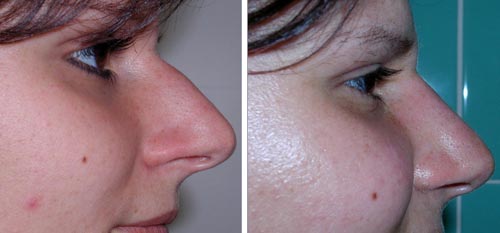 [RhinoplastyPictures.jpg]