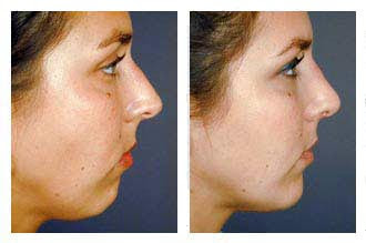 Rhinoplasty Pictures