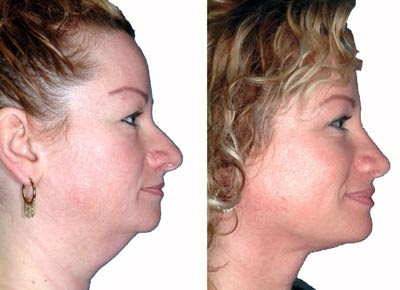 Rhinoplasty Before After