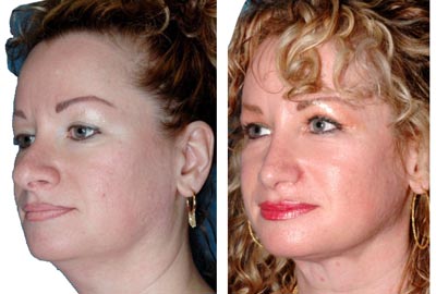 [RhinoplastyBeforeAfter.jpg]