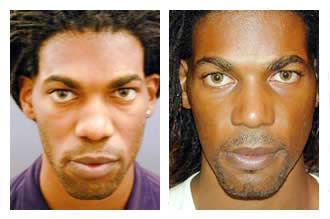 Rhinoplasty Photo