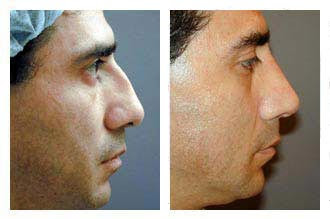 Rhinoplasty Photo