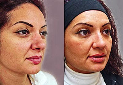 Rhinoplasty Picture