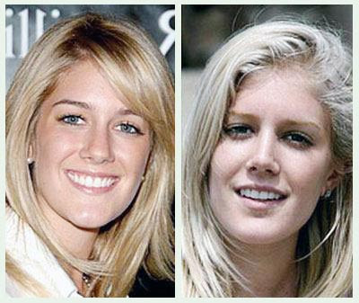 heidi montag plastic surgery before and after people. hair heidi montag before and