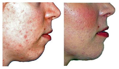 Chin Augmentation Photos