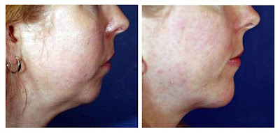 Chin Augmentation Photos