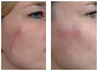 Steroid cream for acne scars