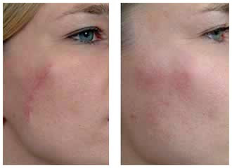Steroid cream acne cyst
