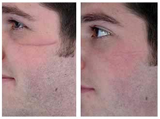 Steroid use acne treatment