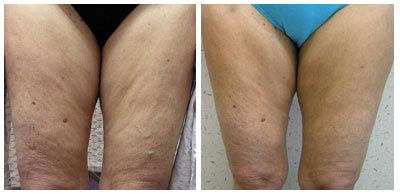 Mesotherapy Results