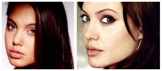 fergie plastic surgery before and after. Angelina Jolie Plastic Surgery