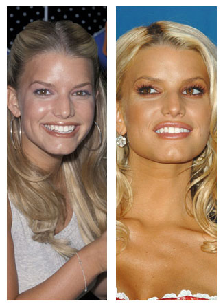 Jessica Simpson Plastic Surgery Before After