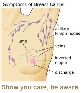 Symptoms Of Breast Cancer