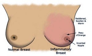 Inflammatory Breast Cancer Symptoms