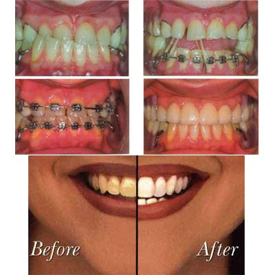 http://2.bp.blogspot.com/_Y_fcCiWe2Qo/Siqg_pHzeJI/AAAAAAAAApE/hAZOhhBexYk/s400/texas%2Bteeth%2Bwhitening.jpg