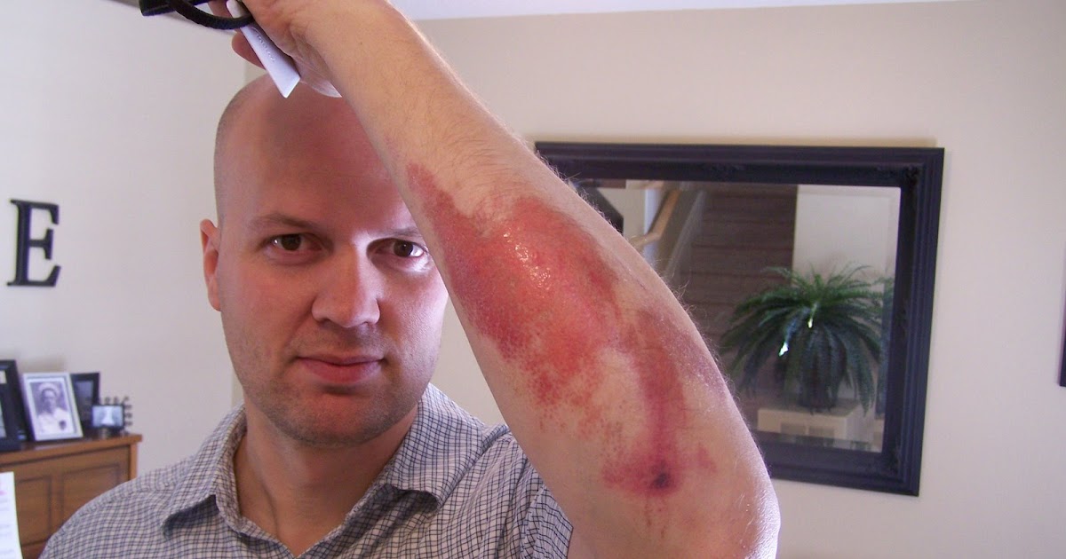 Being Watson 1 Cure for Road Rash