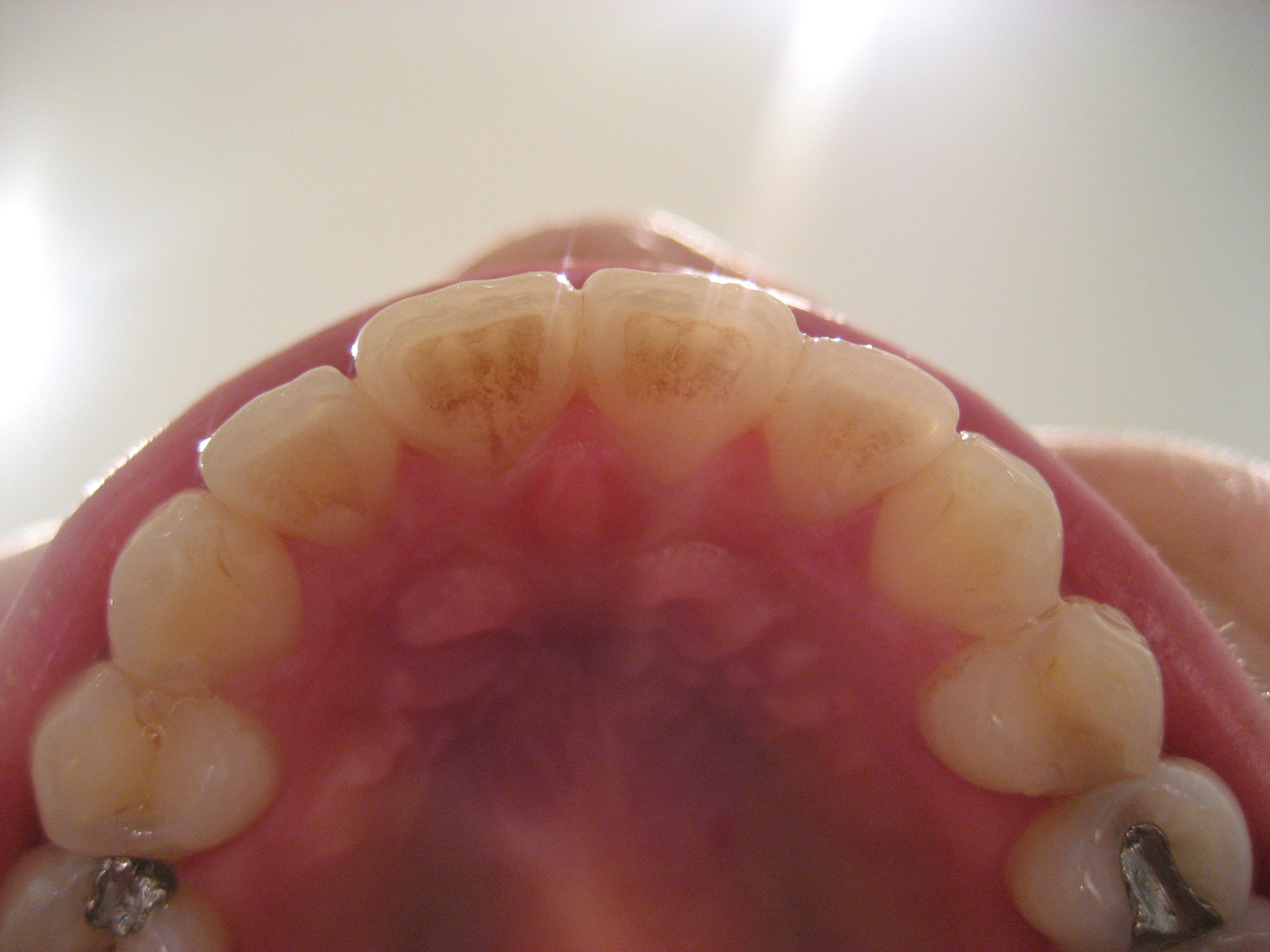 Filing+teeth+after+braces