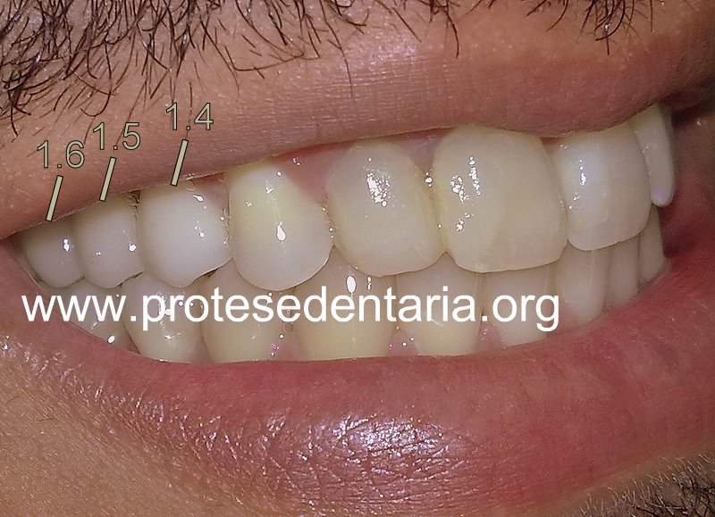 Ponte dentária de cerâmica com 3 dentes (estrutura interna em metal) Prótese Dentária Fixa foto