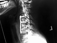 C-Spine Fusion X-Ray