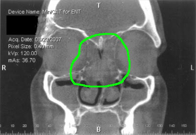 Ct+scan+sinus+polyps