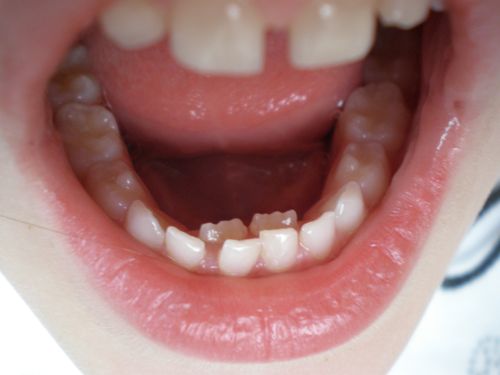My child has two rows of front shark teeth rows. My child has two rows of front