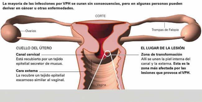 papiloma humano fotos