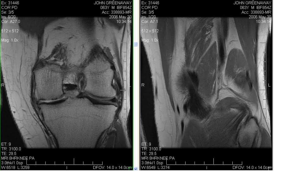 left knee mri