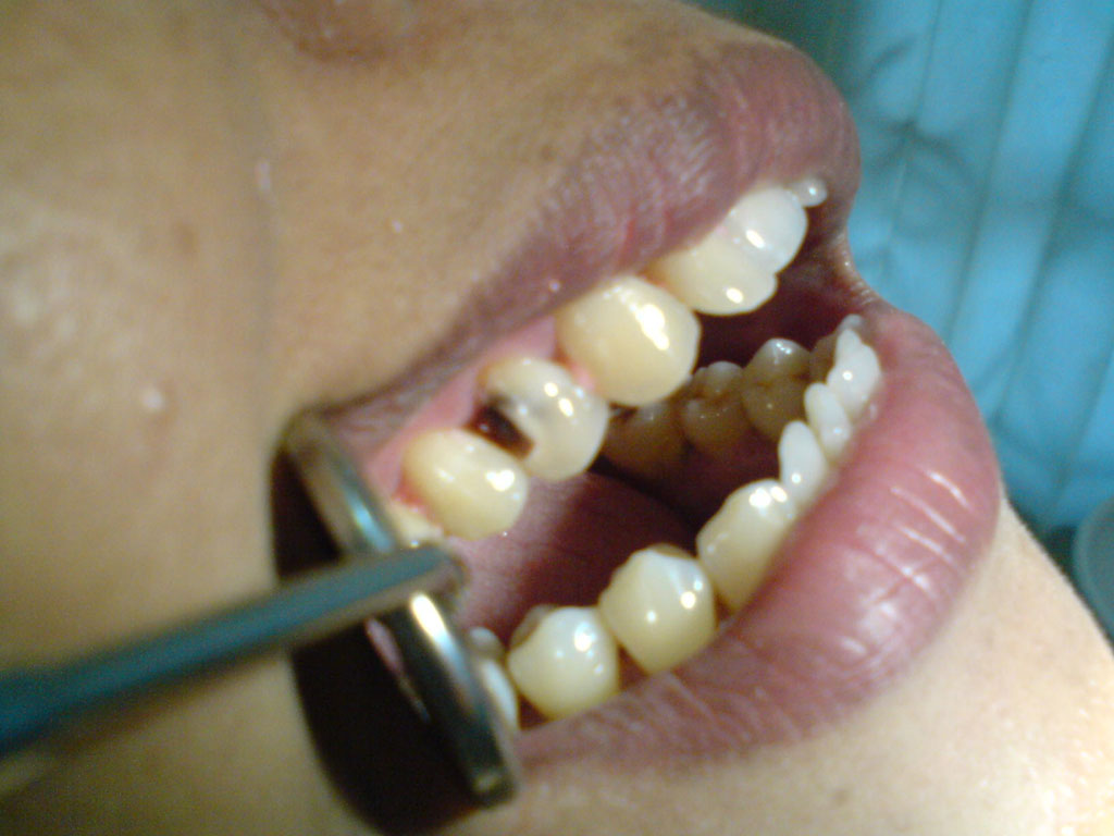 Nala dental Mempercantik Gigi berlubang ( Karies )