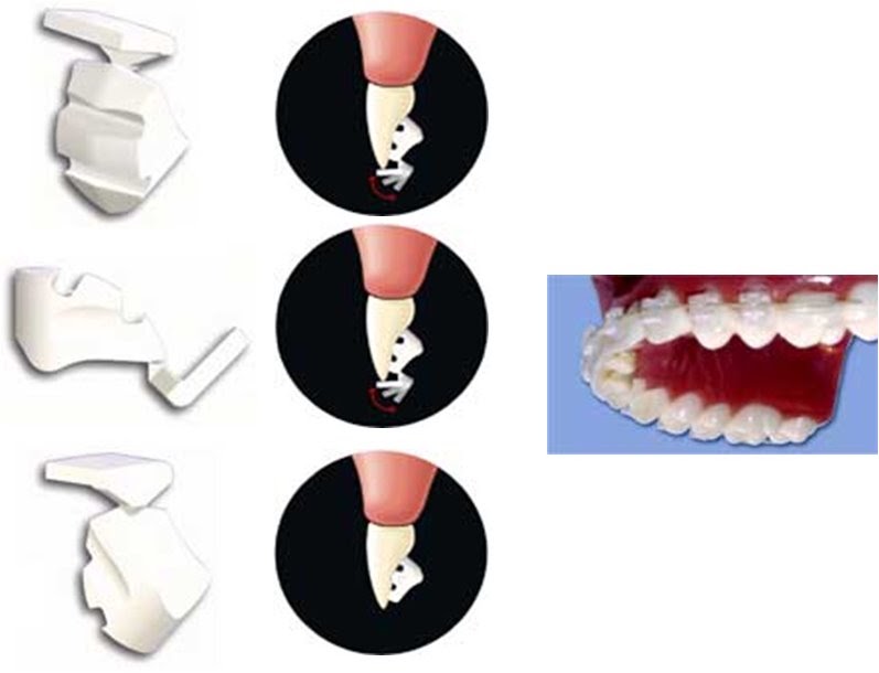 ORTODONTIA CONTEMPORÂNEA BITEBUMPER™