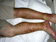 Purpura and edema of lower extremities (hsp )