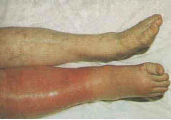 Doctors Gates: Deep venous thrombosis