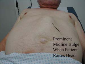 Diastasis Recti Repair