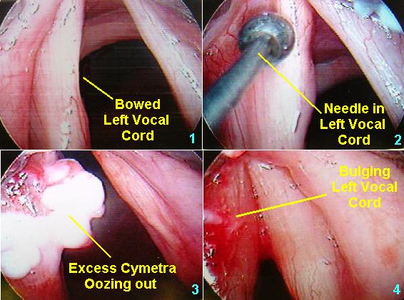 vocal cord nodules