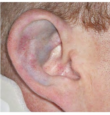 hematoma ear image gallery pinna hematoma hematoma ear image gallery pinna hematoma
