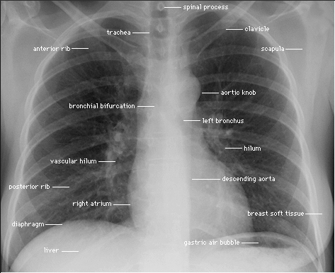 Pa Cxr