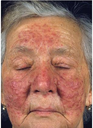 Topical steroids cause rosacea
