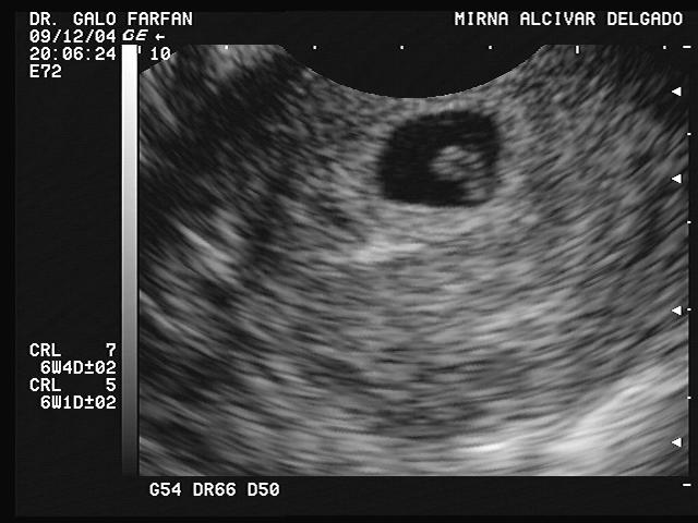 Ecografia de 2 meses de embarazo 2015 - Imagui