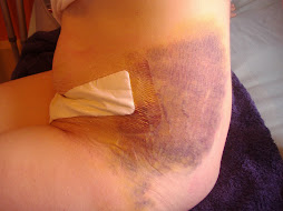 oo-er - my bruise straight after the op (first week)