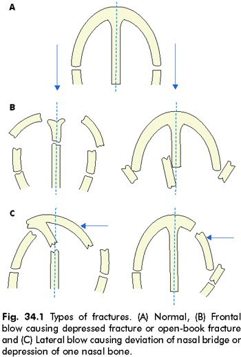 MEDICAL IMAGES: Types of fractures