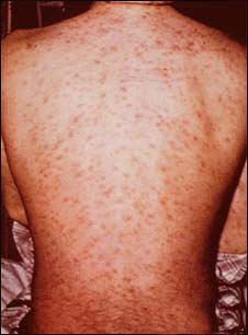allergy on skin