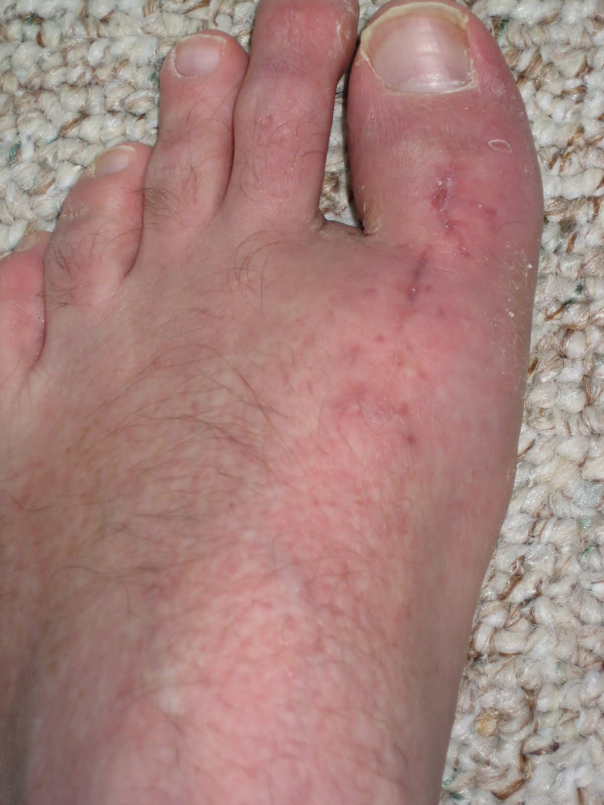 Bones on the big toes - effective treatments 66 Bones on the big toes - effective treatments 12