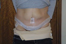 Tummy tuck post op.