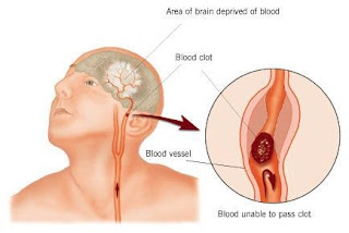 Derrame Cerebral