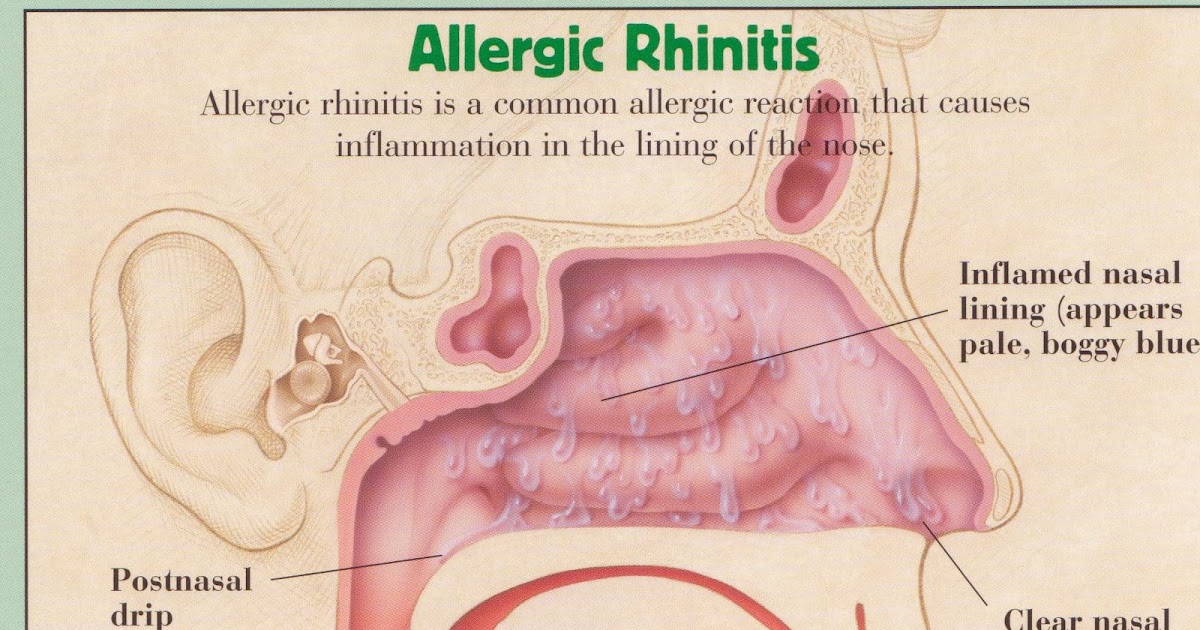 Allergy Dude's Allergy and Asthma Assortments Illustrations of Normal