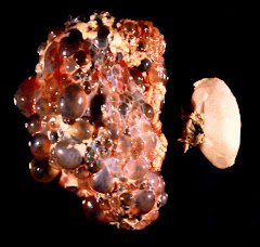 A PKD Kidney