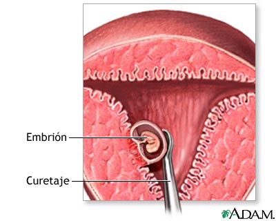FISIOPATOLOGIA ABORTO fisiopatologia aborto:
