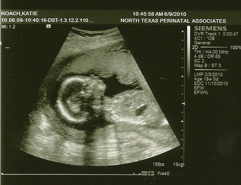 The Roach Family Sonograms